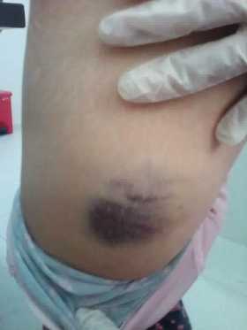 Moretones que le dejó el ataque