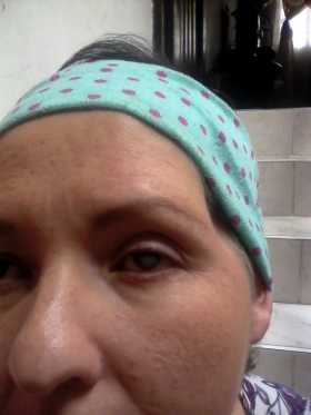 Ahora | Vásquez hoy no ve por el ojo y las quimioterapias hicieron que perdiera parte de su cabello.