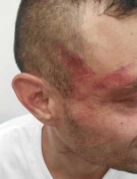 Señales de las lesiones que le provocaron en el rostro a la víctima.