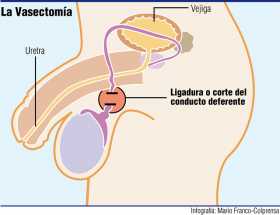 Vasectomía