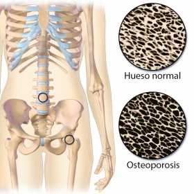 Florencia, pendiente de medicamentos de Coomeva para combatir la osteoporosis