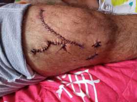 Así le quedó la pierna al policía.