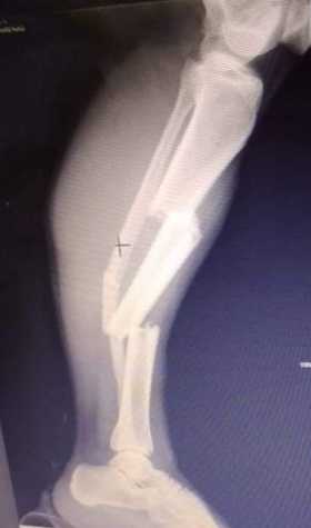 Yeimi Lorena Cardona Arenas, con fractura en tibia y peroné de la pierna derecha. Trasladada a Manizales.