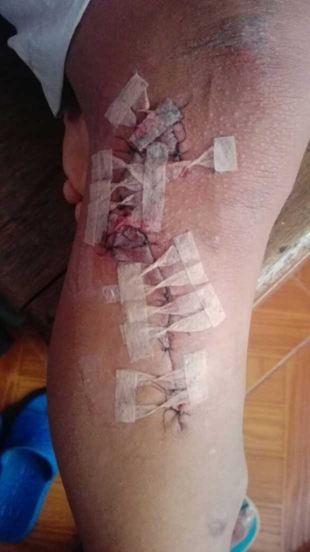 Esta es la herida sufrida por el alumno de la Normal San José de Pácora.
