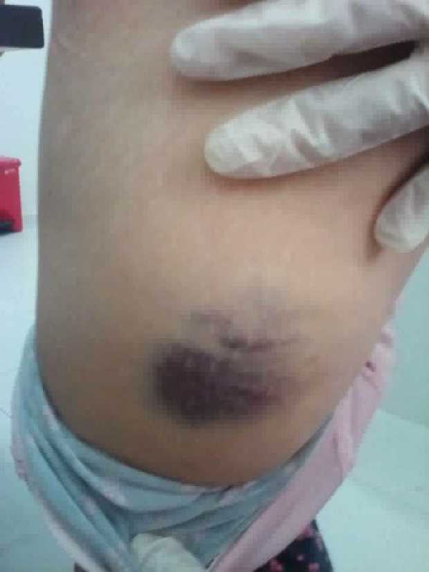 Moretones que le dejó el ataque