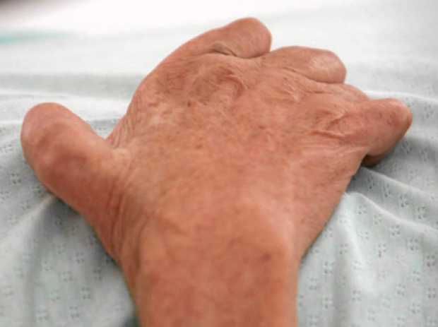 La mano de garra es una consecuencia de la lepra, que impide la circulación. 