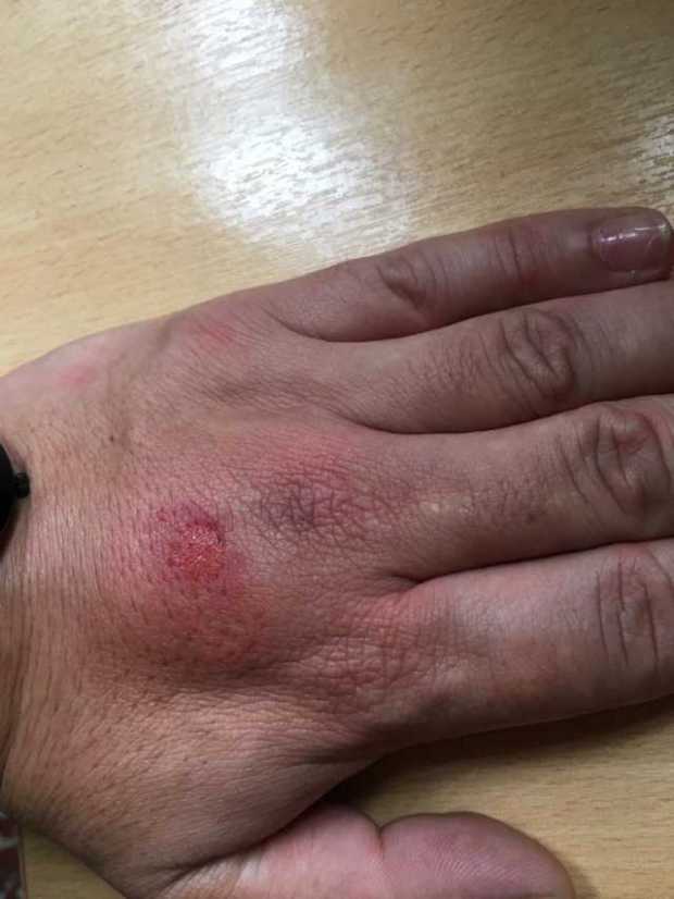 Así quedó la mano del policía. Así quedó la mano del policía.