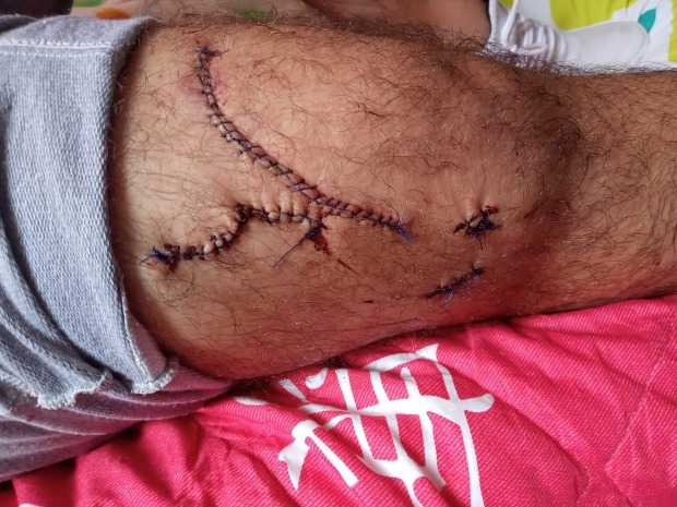 Así le quedó la pierna al policía.