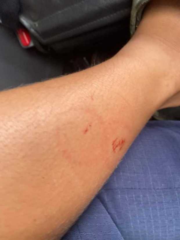 A niño de 9 años lo mordió una serpiente en Norcasia A niño de 9 años lo mordió una serpiente en Norcasia